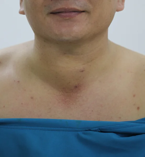 Vùng cổ bệnh nhân trước khi phẫu thuật tuyến giáp