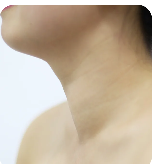 Vùng cổ bệnh nhân sau khi điều trị RFA