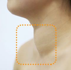 Bệnh nhân chưa được điều trị bướu cổ.