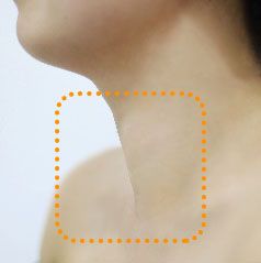 Bệnh nhân đã được được điều trị bướu cổ bằng sóng cao tần.