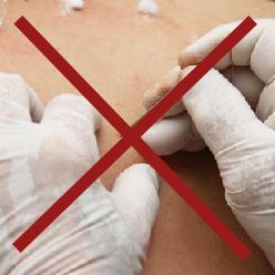 Dùng kim châm vào bướu gây nhiễm trùng, khiến bệnh trầm trọng hơn