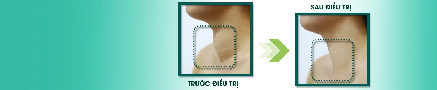 Sóng cao tần