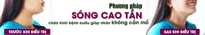 phuong-phap-dieu-tri-buou-co-bang-song-cao-tan