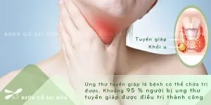 BC - UNG THU TUYEN GIAP TRI KHOI KHONG 02042021