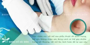 BC - CHAM SOC SAU PHAU THUAT UNG THU 11052021